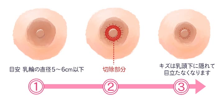陥没乳頭 乳輪縮小 モントゴメリー腺除去は 京都 滋賀の大西皮フ科形成外科医院