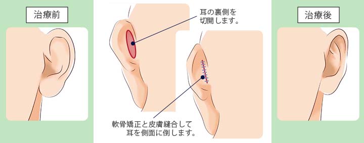 耳の形成（立ち耳・耳垂型など）｜京都・滋賀の大西皮フ科形成外科医院