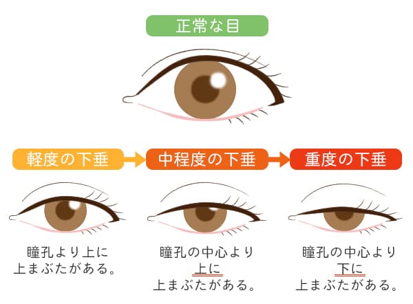 切らない眼瞼下垂の手術は 京都 滋賀の大西皮フ科形成外科医院