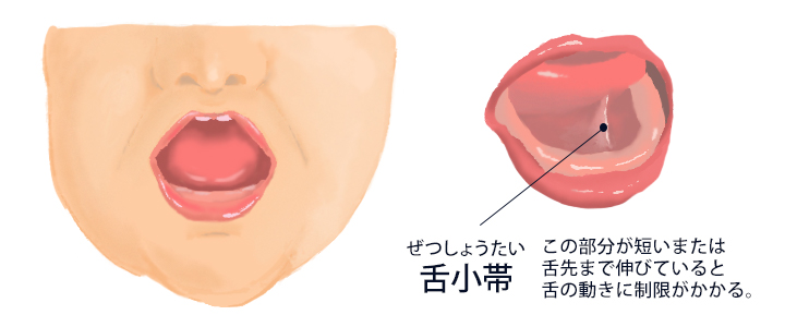 舌小帯短縮症 は京都 滋賀の大西皮フ科形成外科医院へ