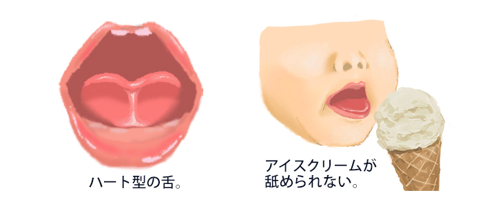 舌小帯短縮症 は京都 滋賀の大西皮フ科形成外科医院へ